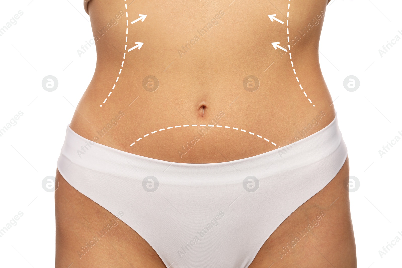 Image of Woman with markings for cosmetic surgery on her abdomen against white background, closeup