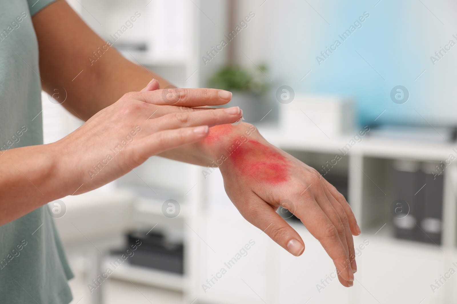 Photo of Woman applying healing cream onto burned hand indoors, closeup