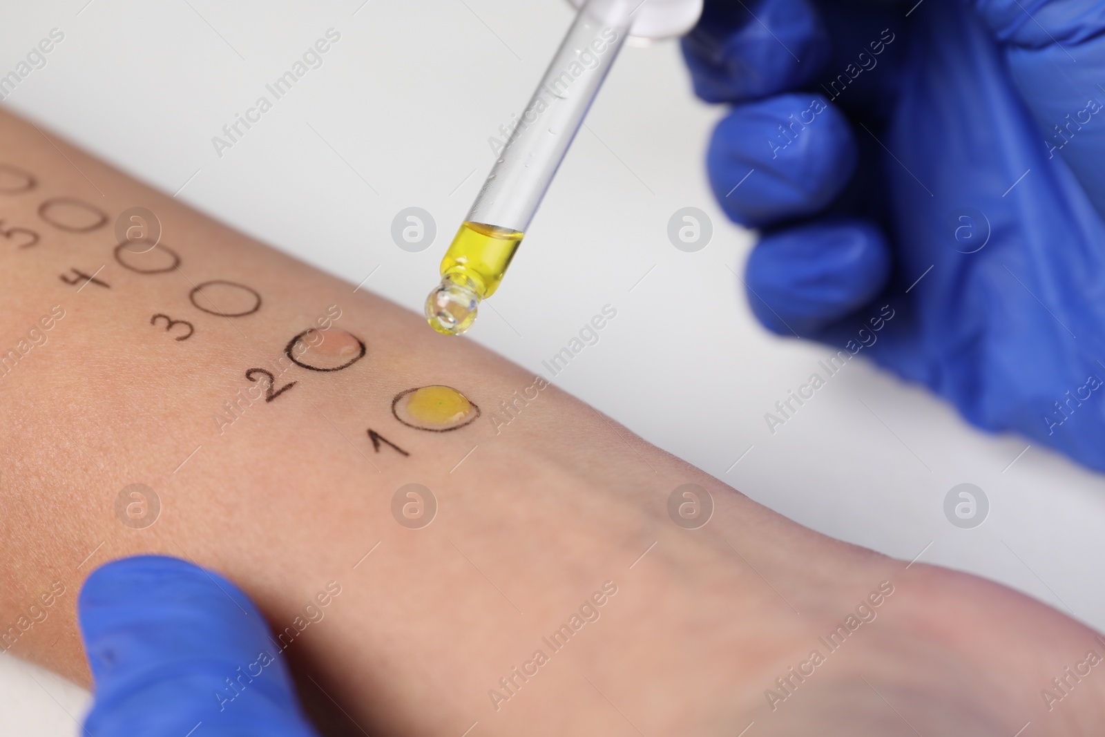 Photo of Doctor doing skin allergy test at light table, closeup