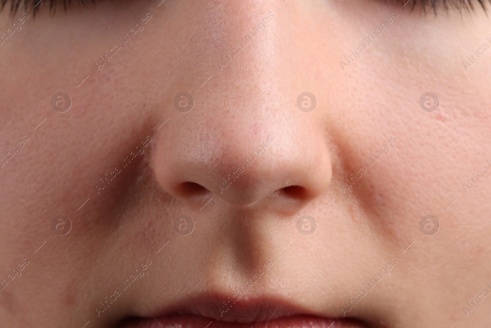 Photo of Young woman with acne problem, closeup view