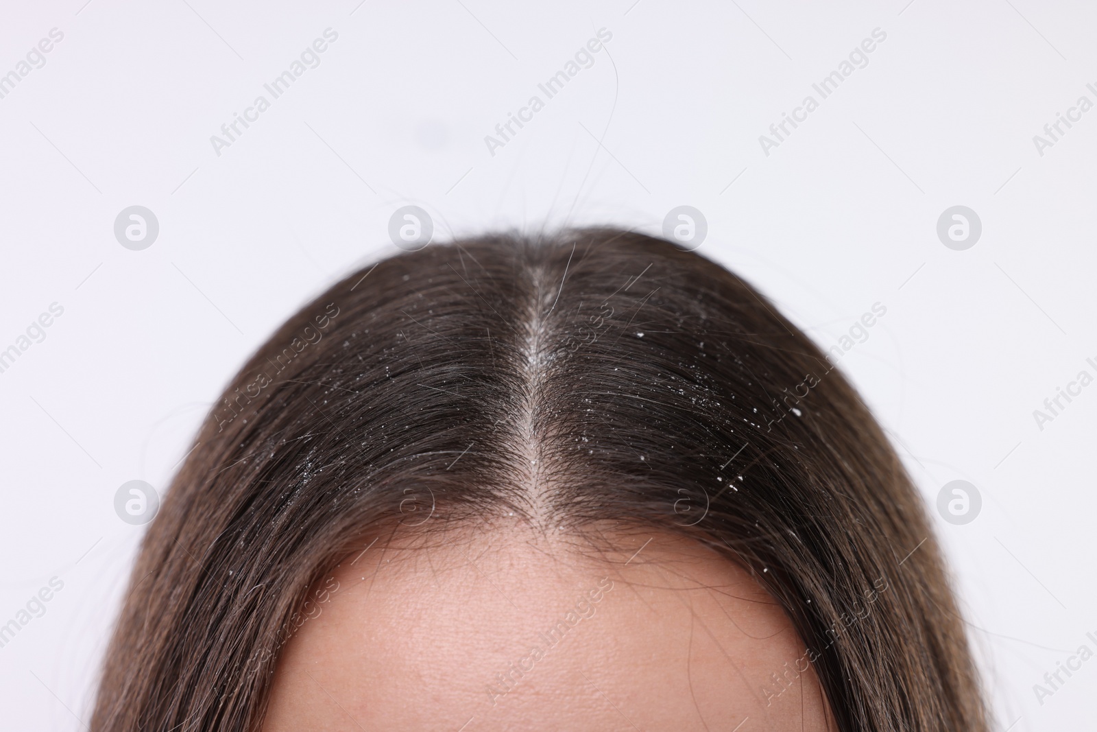 Photo of Woman with dandruff problem on white background, closeup