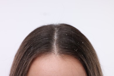 Woman with dandruff problem on white background, closeup