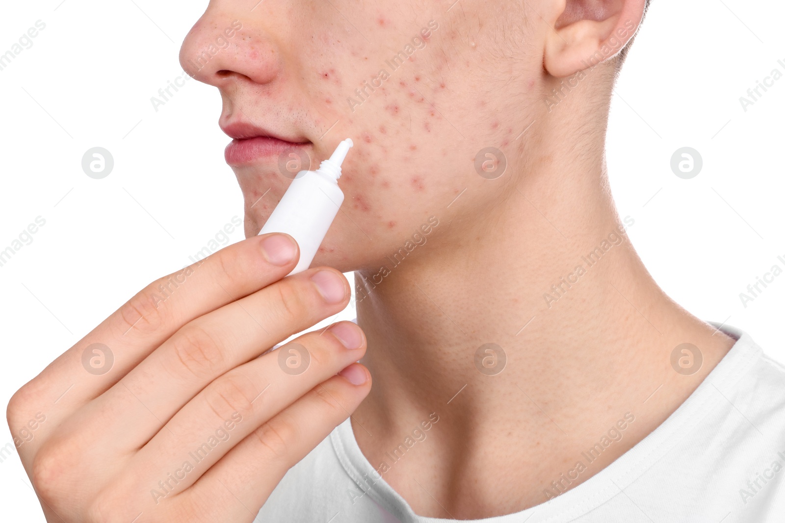 Photo of Young man with acne problem applying cosmetic product onto his skin on white background, closeup