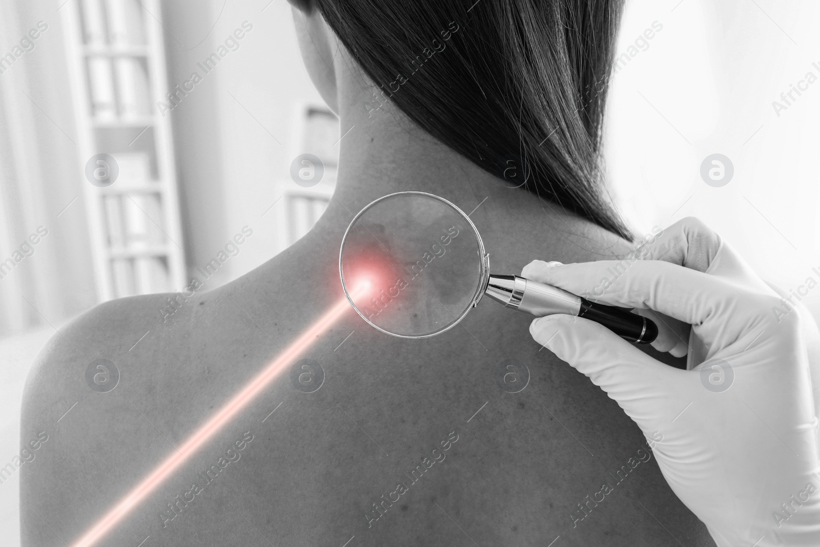 Image of Laser mole removal. Doctor looking at patient's skin through magnifying glass during procedure in clinic, closeup. Black and white effect