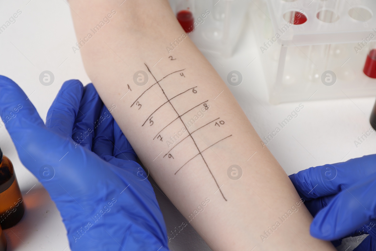 Photo of Doctor doing skin allergy test at light table, closeup