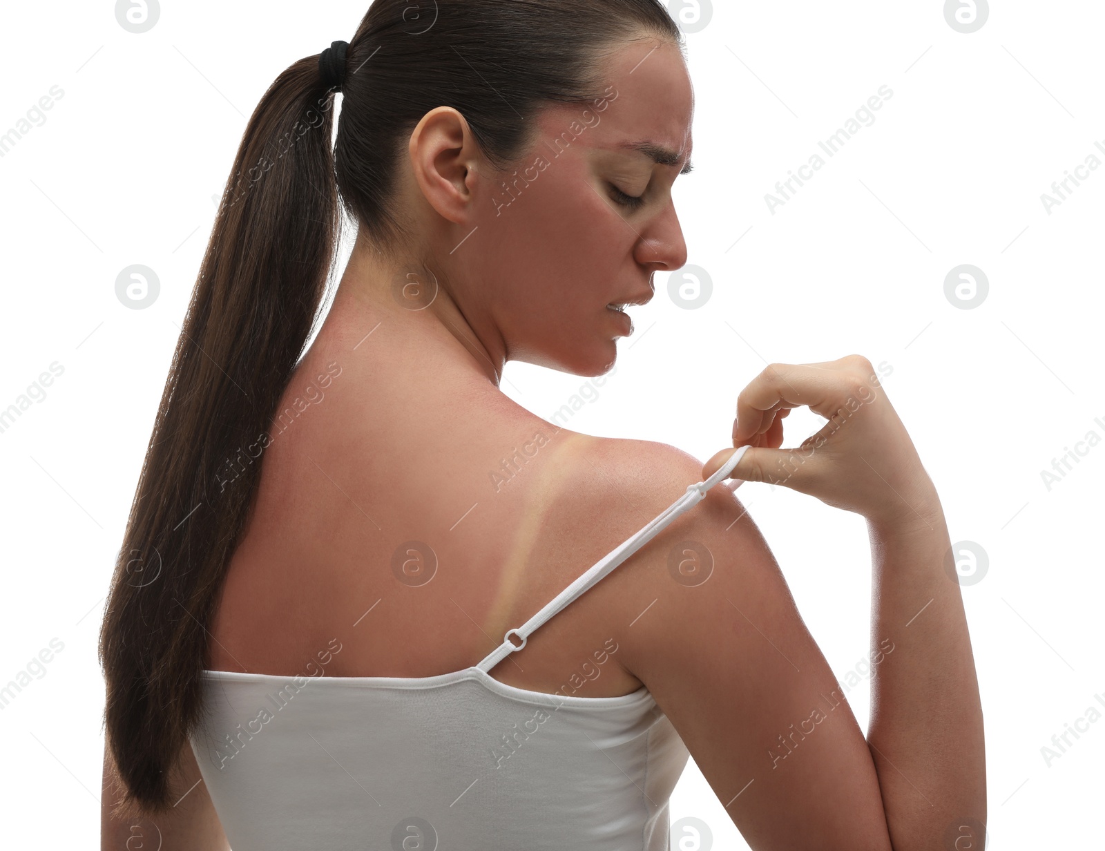 Photo of Woman with sunburned skin on white background