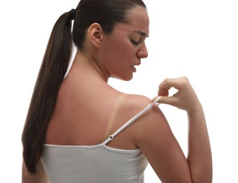 Photo of Woman with sunburned skin on white background