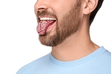 Image of Dry mouth symptom. Man showing dehydrated tongue on white background, closeup