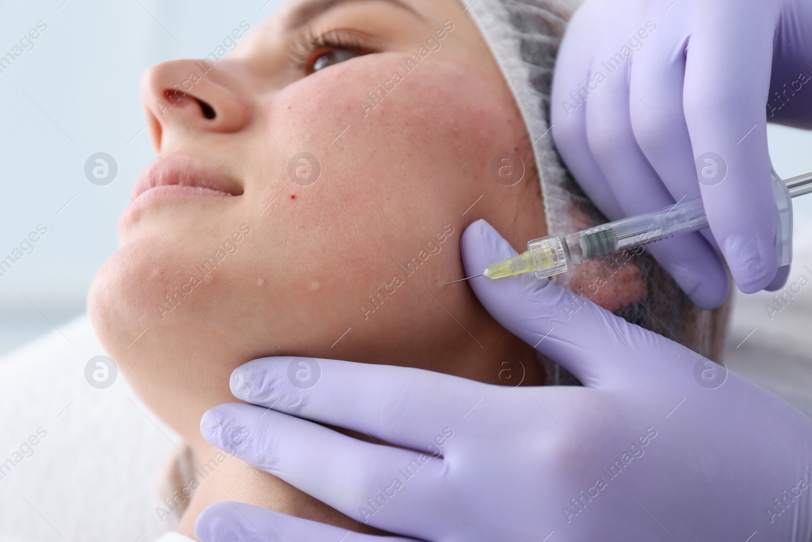 Photo of Woman undergoing face biorevitalization procedure in salon, closeup. Cosmetic treatment