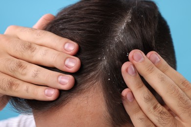 Photo of Man with dandruff in his dark hair on light blue background, closeup