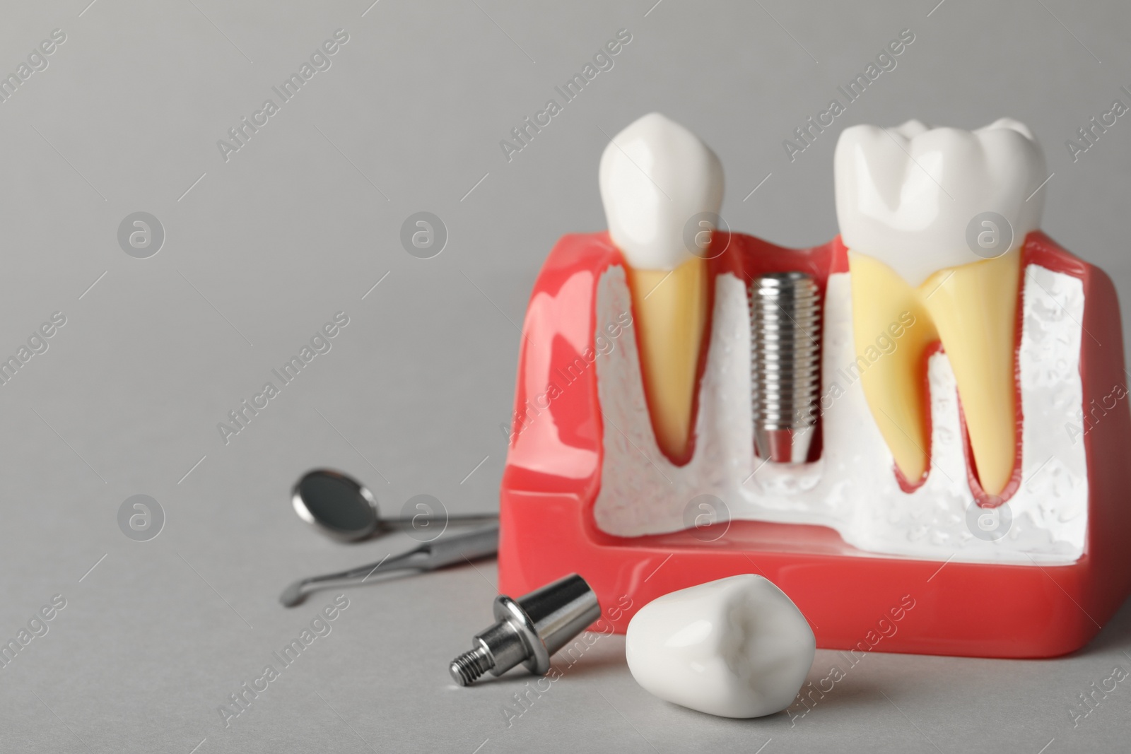 Photo of Educational model of gum with post for dental implant between teeth and crown on grey background