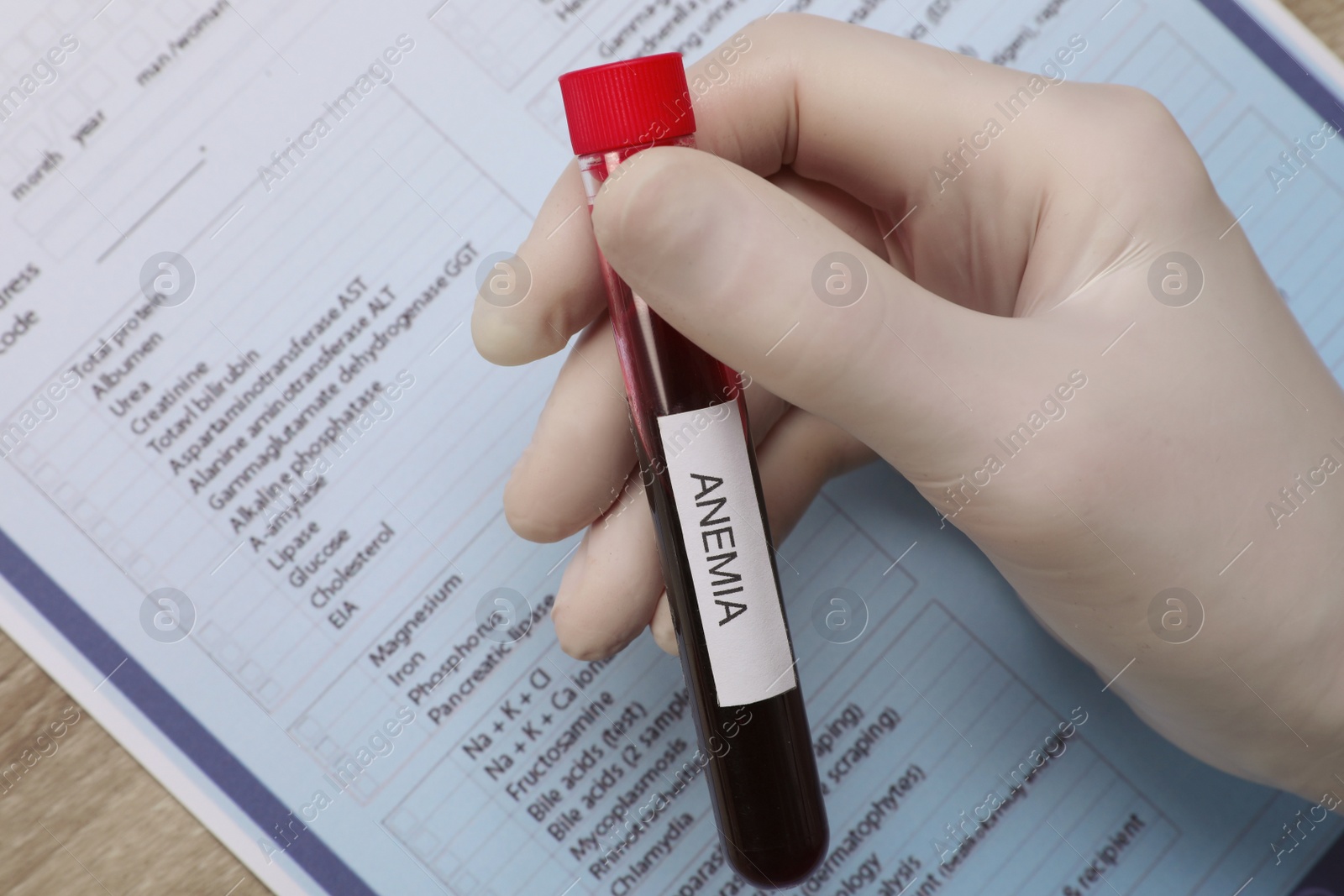 Photo of Doctor holding test tube with blood sample and label Anemia over medical form, top view