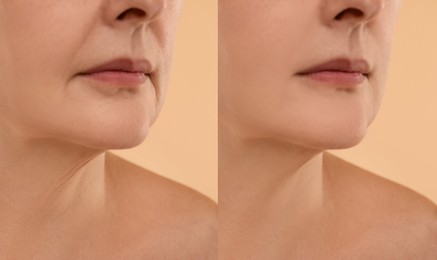 Image of Aging skin changes. Woman showing neck before and after rejuvenation, closeup. Collage comparing skin condition