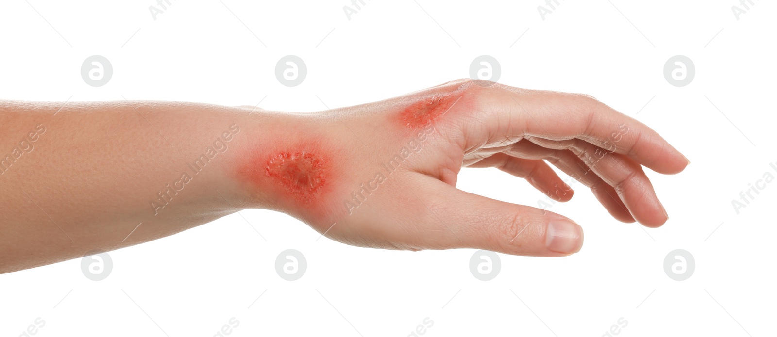 Photo of Woman with burned hand on white background, closeup