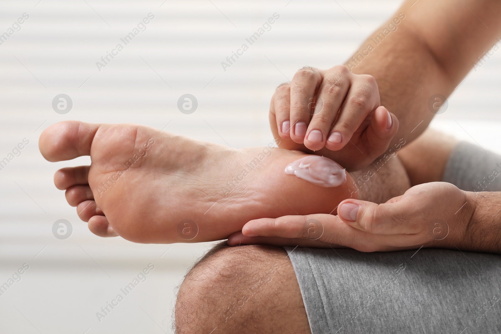 Photo of Man with dry skin applying cream onto his foot on light background, closeup