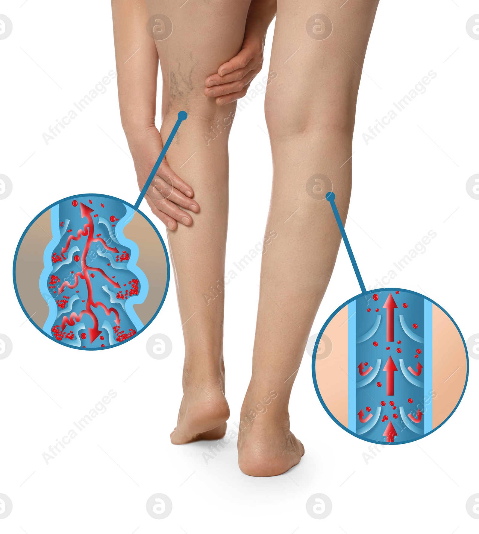 Image of Closeup view of woman with varicose veins on white background. Illustrations of damaged and healthy vein, longitudinal section