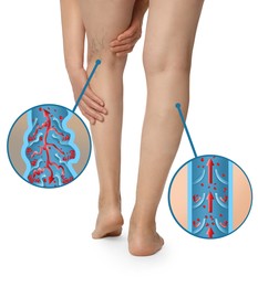 Image of Closeup view of woman with varicose veins on white background. Illustrations of damaged and healthy vein, longitudinal section