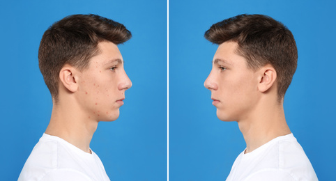 Image of Teenager before and after acne treatment on blue background