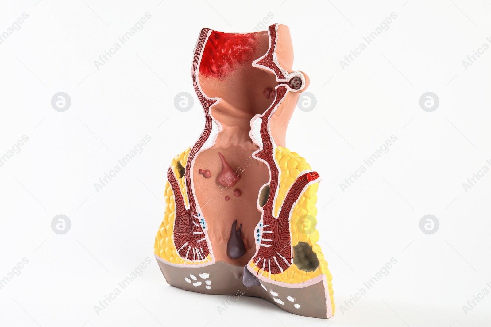 Photo of Anatomical model of rectum with hemorrhoids isolated on white