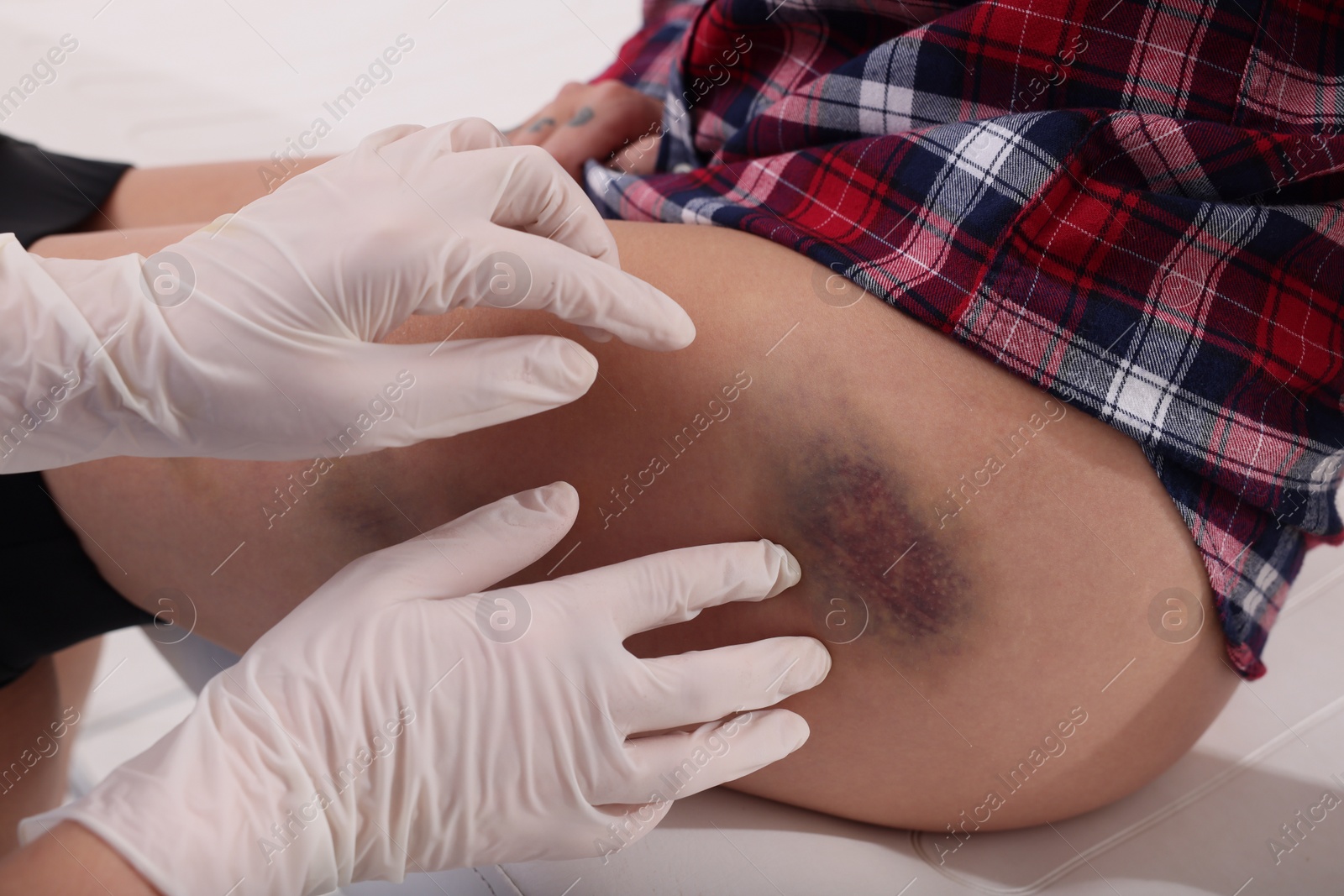 Photo of Doctor examining patient's bruised hip in hospital, closeup