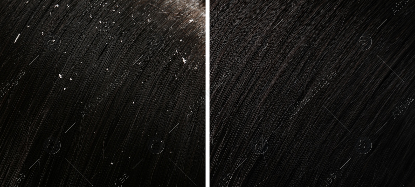 Image of Woman showing hair before and after dandruff treatment, collage