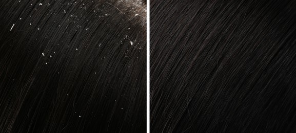 Image of Woman showing hair before and after dandruff treatment, collage