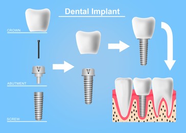 Image of Structure of dental implant on light blue background, illustration. Educational poster