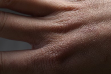 Photo of Woman with dry skin on hand, closeup