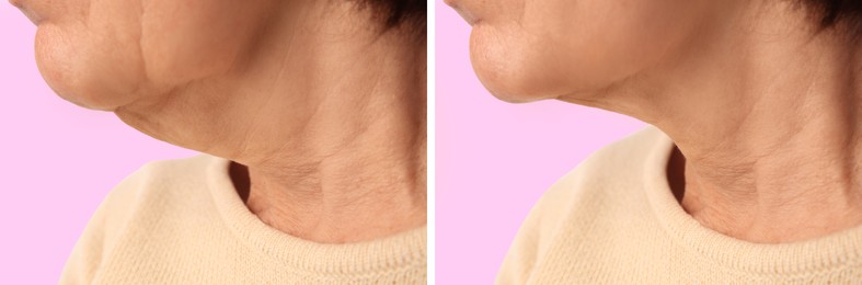 Double chin problem. Collage with photos of mature woman before and after skin tightening treatments on pink background, closeup