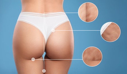 Image of Cellulite problem. Slim woman in underwear on light blue background, closeup. Zoomed skin areas with orange peel syndrome