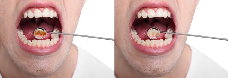 Collage with photos of man before and after professional treatment of dental plaque on white background, closeup. Banner design