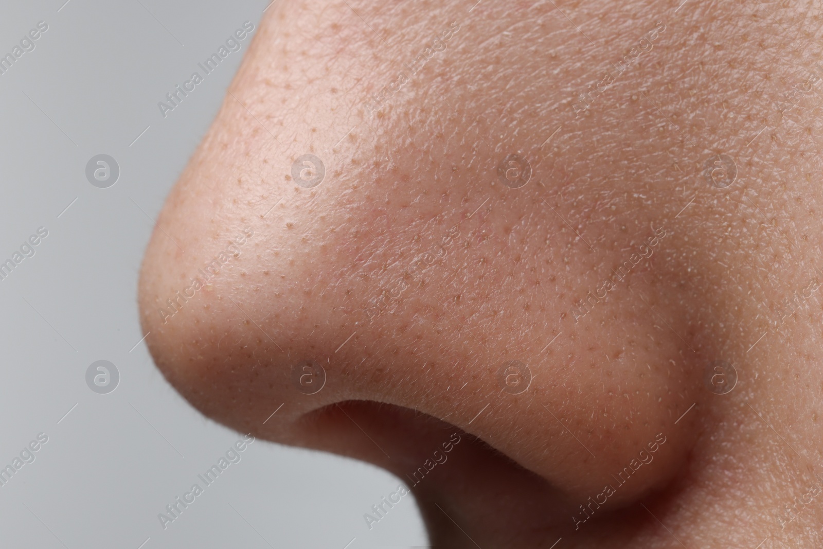 Photo of Young woman with acne problem on white background, closeup view of nose