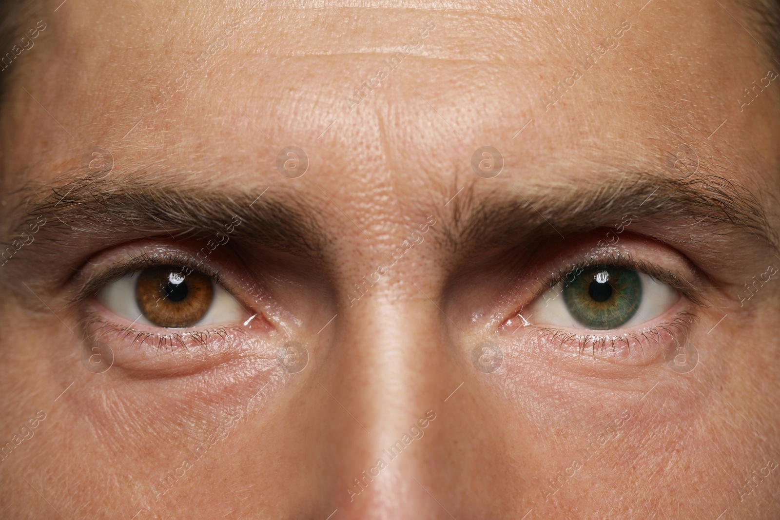 Image of Man with beautiful eyes of different colors, closeup. Heterochromia iridis