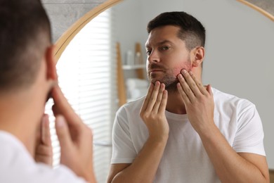 Photo of Man suffering from allergy looking at his skin in mirror indoors