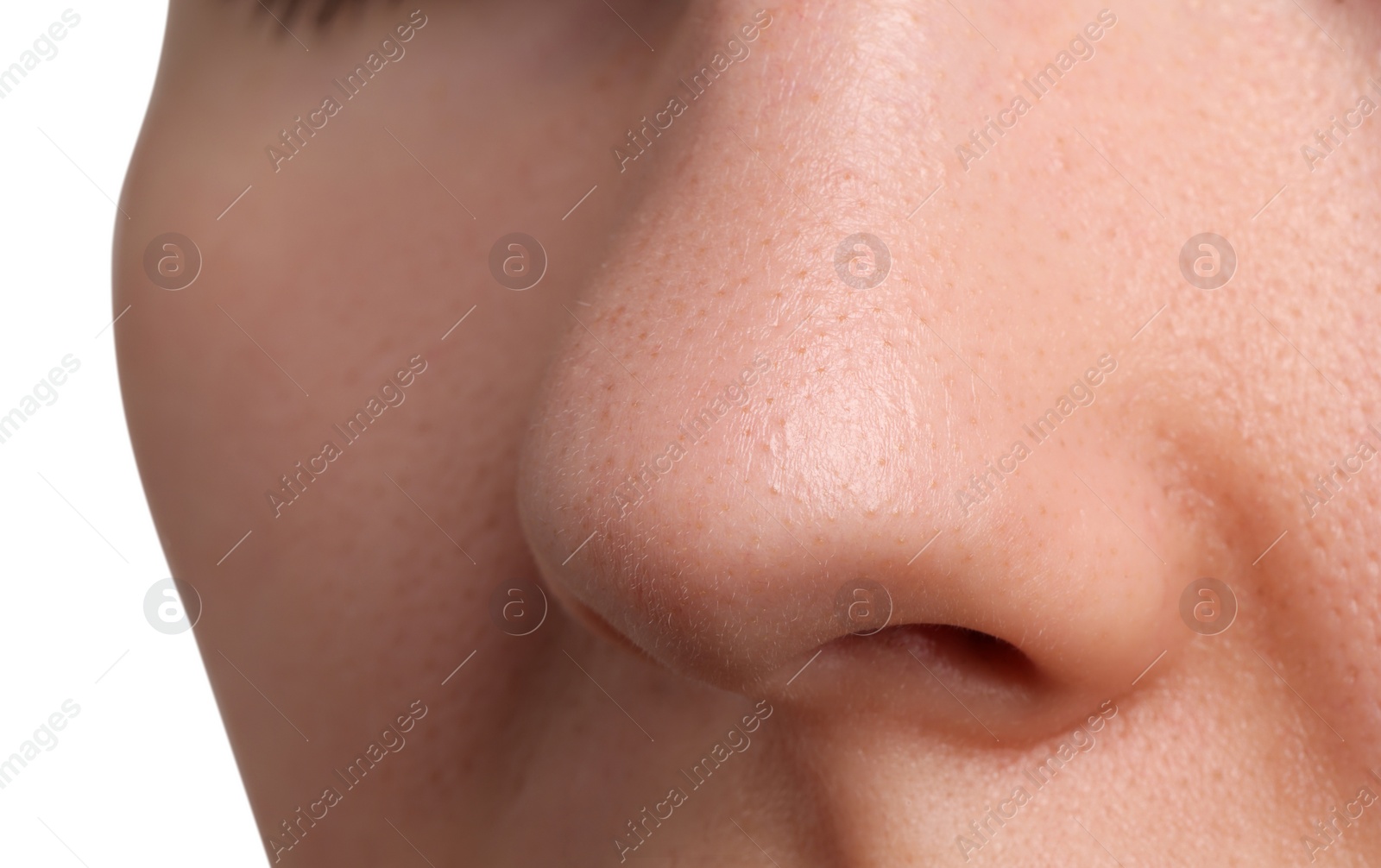 Photo of Young woman with acne problem on white background, closeup view of nose