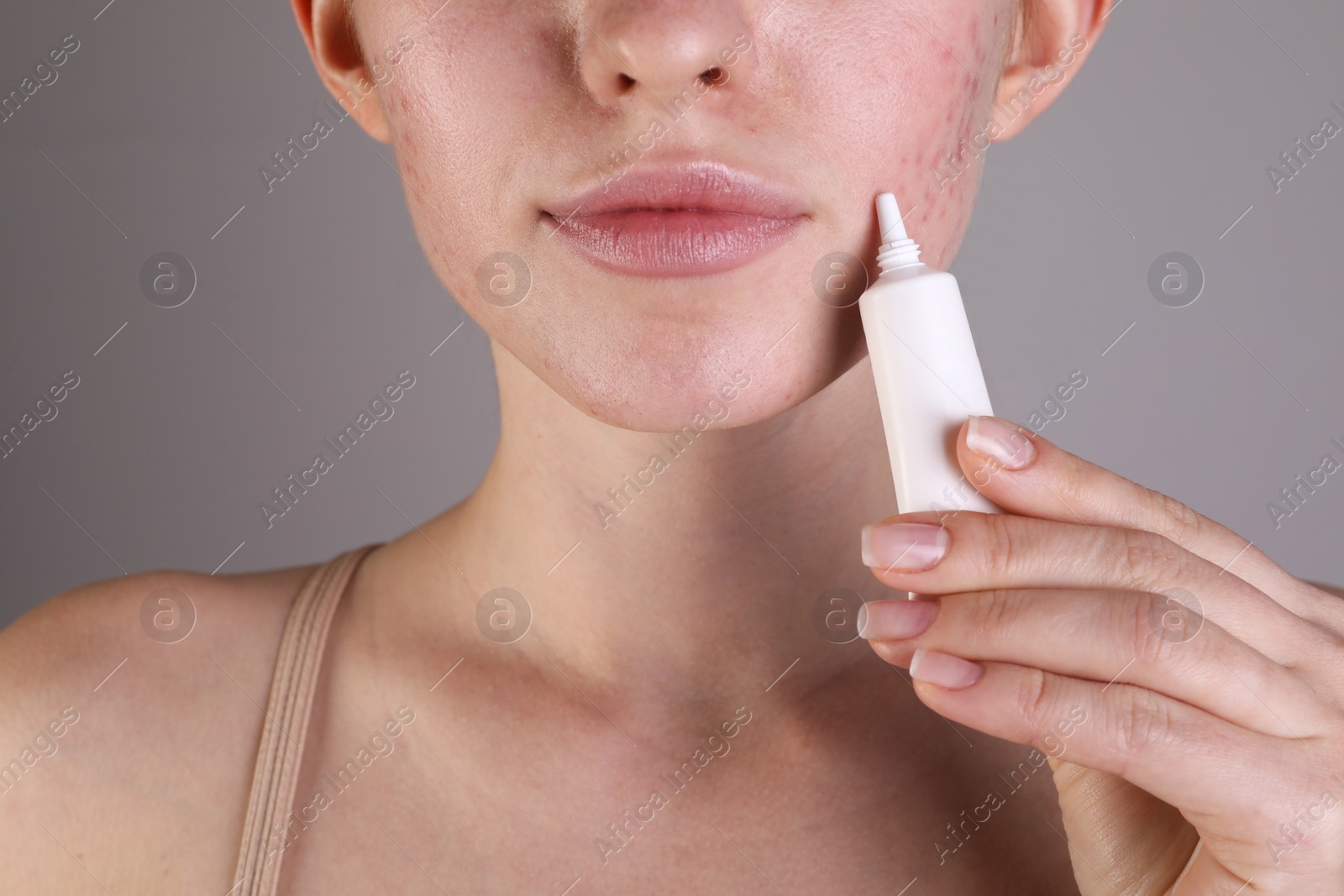 Photo of Young woman with acne problem applying cosmetic product onto her skin on light grey background, closeup