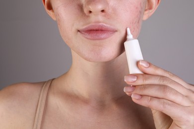 Young woman with acne problem applying cosmetic product onto her skin on light grey background, closeup