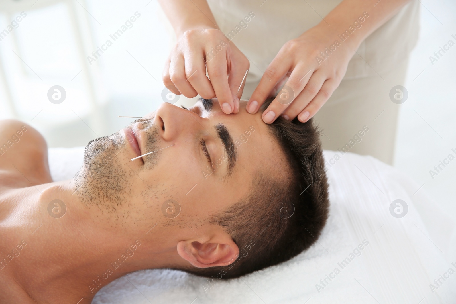 Photo of Young man undergoing acupuncture treatment in salon