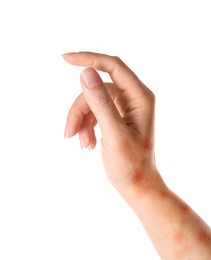 Woman showing hand with dry skin on white background, closeup