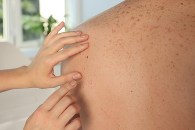 Dermatologist examining patient's birthmark indoors, closeup view