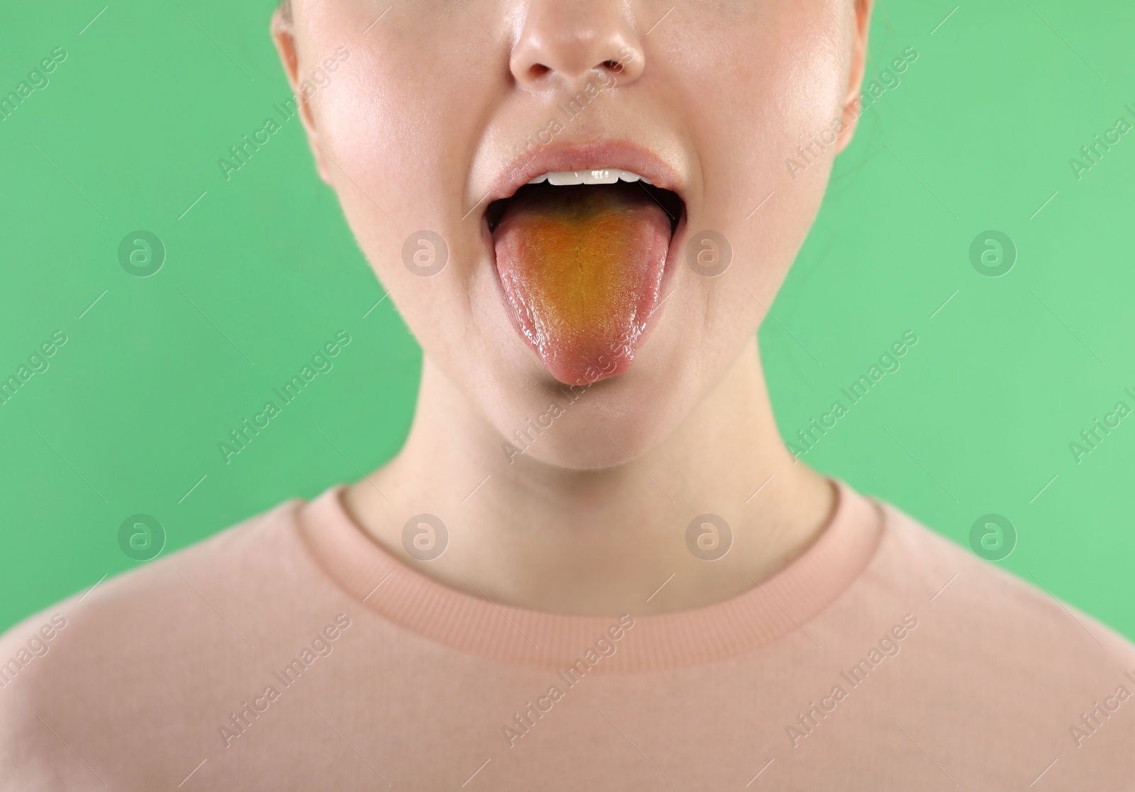 Photo of Gastrointestinal diseases. Woman showing her yellow tongue on green background, closeup