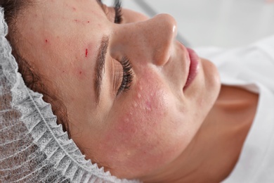 Woman after face biorevitalization procedure in salon, closeup. Cosmetic treatment