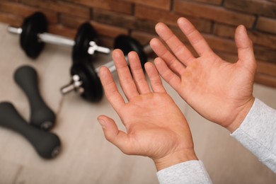 Photo of Man suffering from calluses on hands indoors, closeup