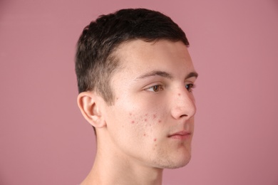 Young man with acne problem on color background