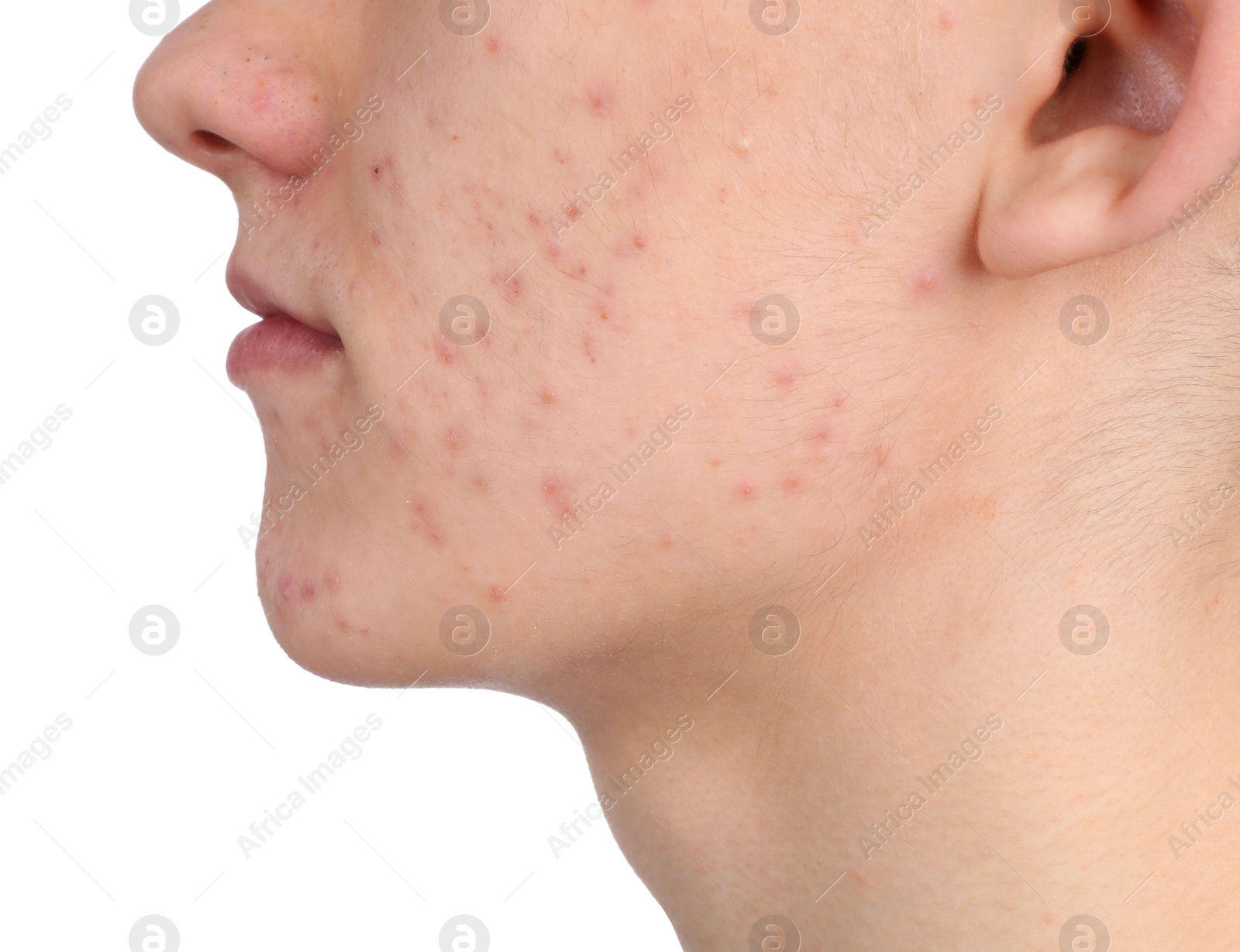 Photo of Young man with acne problem isolated on white, closeup