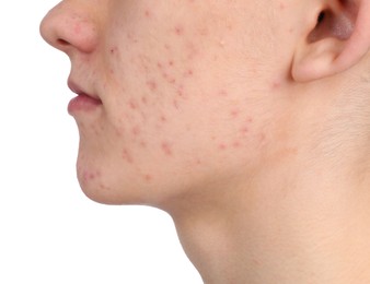 Young man with acne problem isolated on white, closeup