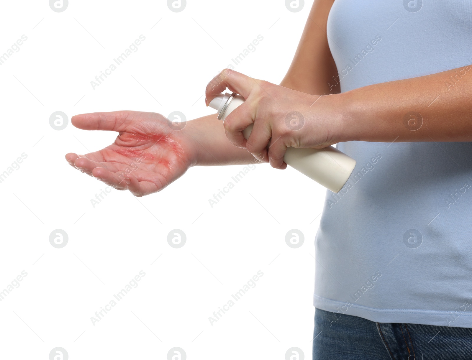 Photo of Woman applying panthenol onto burned hand on white background, closeup