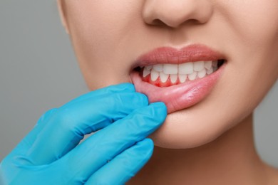 Doctor examining woman's inflamed gum on grey background, closeup