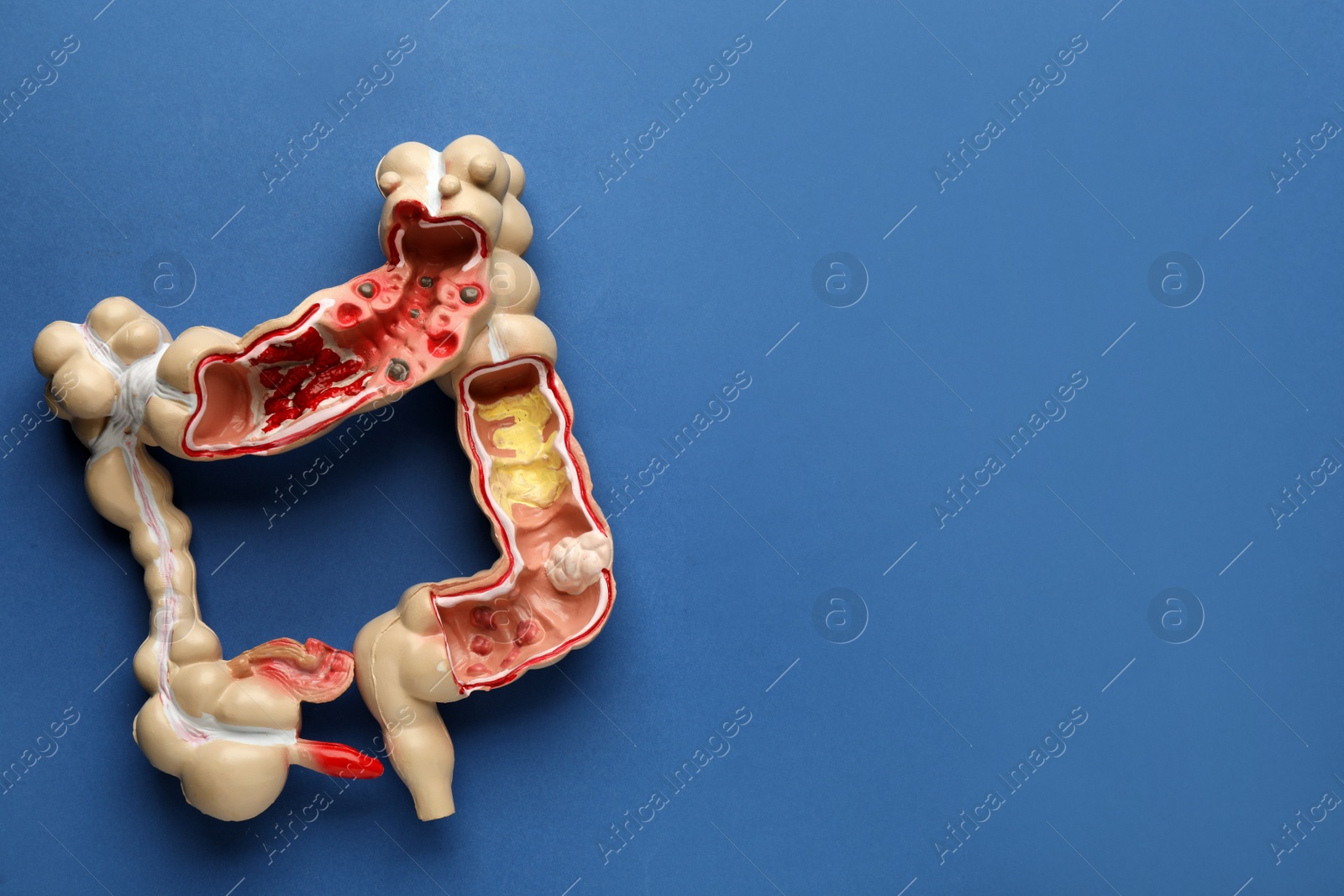Photo of Anatomical model of large intestine on blue background, top view with space for text. Gastroenterology