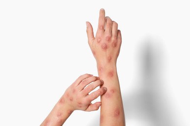 Photo of Woman with rash suffering from monkeypox virus on white background, closeup